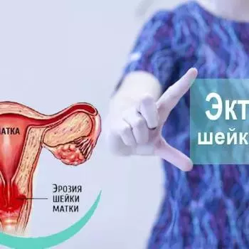Что такое эктопия шейки матки? Как лечить эктопию шейки матки?